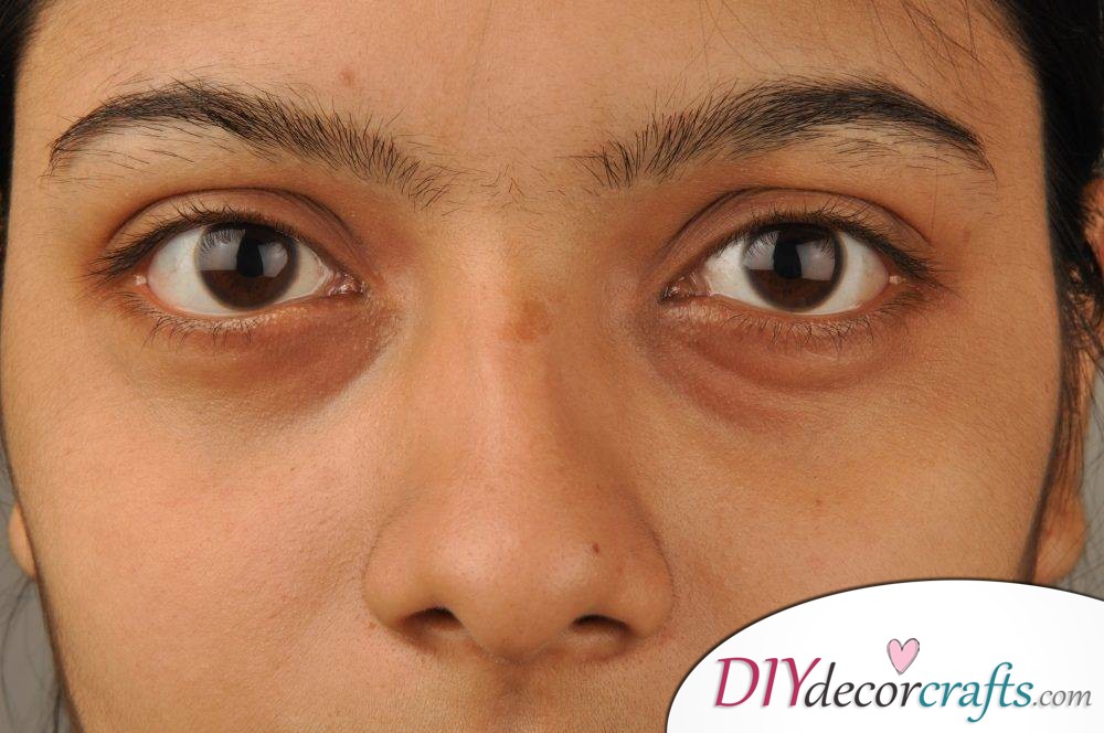 How To Get Rid Of Eye Bags Easily, Swollen Eyes